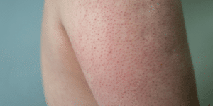 Keratosis Pilaris can be reduced by exfoliating and hydrating the skin.